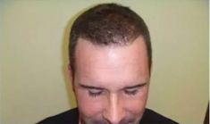 Haartransplantation - Vorher Foto - Prohaarklinik