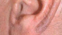 Laser hair removal - Photo before - Klinika Laser Esthetic