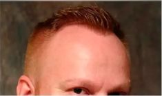 Haartransplantation - Vorher Foto - Prohaarklinik