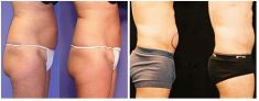 Liposuzione ultrasonica - Foto del prima - Dr. Luigi Mazzi