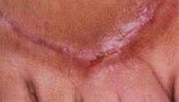 Radiofrequency Rejuvenation (Aluma, accent, TriPollar, Spa RF device, Re-Age) - Photo before - Klinika Laser Esthetic