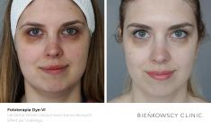Spider veins laser removal (redness, birh marks) - Photo before - Bieńkowscy Clinic®