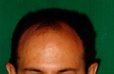 Implante capilar - Foto Antes de - Dr. Aristides Arellano-Huacuja