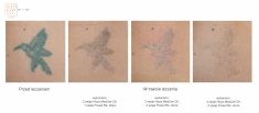 Tattoo removal - Photo before - Bieńkowscy Clinic®