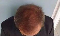 Haartransplantation - Vorher Foto - Prohaarklinik