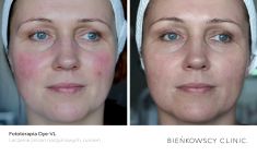 Spider veins laser removal (redness, birh marks) - Photo before - Bieńkowscy Clinic®