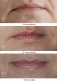 Fat (lipofiling) - Photo before - Dr n. med. Marcin Bieńkowski