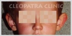 Ear surgery (Otoplasty) - Photo before - Cleopatra Clinic, Klinika Plastické Chirurgie s.r.o.