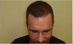 Haartransplantation - Vorher Foto - Prohaarklinik