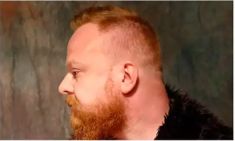 Haartransplantation - Vorher Foto - Prohaarklinik