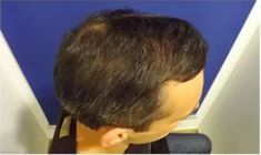 Haartransplantation - Vorher Foto - Prohaarklinik