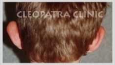 Ear surgery (Otoplasty) - Photo before - Cleopatra Clinic, Klinika Plastické Chirurgie s.r.o.