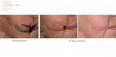 Laser Scar Treatment - Photo before - Dr n. med. Marcin Bieńkowski
