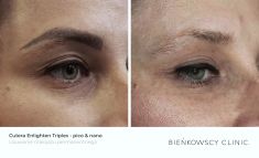 Tattoo removal - Photo before - Bieńkowscy Clinic®