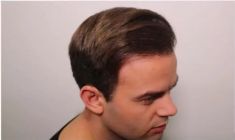 Haartransplantation - Vorher Foto - Prohaarklinik