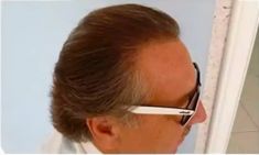 Haartransplantation - Vorher Foto - Prohaarklinik