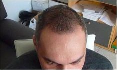 Haartransplantation - Vorher Foto - Prohaarklinik