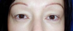 Eyelid surgery (Blepharoplasty) - Photo before - Klinika Laser Esthetic