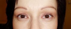 Eyelid surgery (Blepharoplasty) - Photo before - Klinika Laser Esthetic