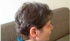 Haartransplantation - Vorher Foto - Prohaarklinik