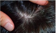 Haartransplantation - Vorher Foto - Prohaarklinik
