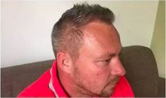 Haartransplantation - Vorher Foto - Prohaarklinik