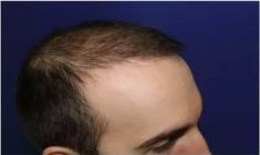 Haartransplantation - Vorher Foto - Prohaarklinik