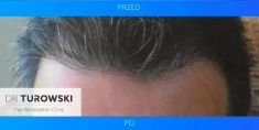 Hair Transplant - Photo before - Dr Turowski Hair Restoration Clinic