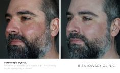 Spider veins laser removal (redness, birh marks) - Photo before - Bieńkowscy Clinic®