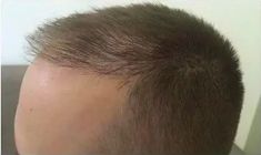 Haartransplantation - Vorher Foto - Prohaarklinik