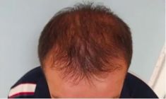 Haartransplantation - Vorher Foto - Prohaarklinik