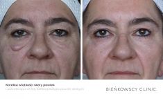 Eyelid surgery (Blepharoplasty) - Photo before - Dr n. med. Marcin Bieńkowski