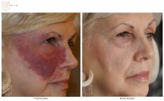 - Photo before - Bieńkowscy Clinic®