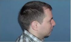 Haartransplantation - Vorher Foto - Prohaarklinik