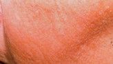 Radiofrequency Rejuvenation (Aluma, accent, TriPollar, Spa RF device, Re-Age) - Photo before - Klinika Laser Esthetic