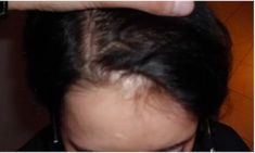 Haartransplantation - Vorher Foto - Prohaarklinik