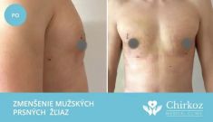 Zväčšenie prsníkov (Augmentácia) - Fotka pred - Chirkoz Medical Clinic