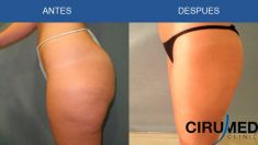Liposucción - Foto Antes de - Cirumed Clinic