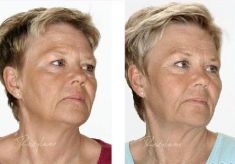 Hyaluronic acid-based wrinkle fillers - Photo before - Dr. Dobos Calin