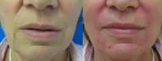 Injekční výplně - fotka před - MUDr. Evžen Trupar Ph.D.