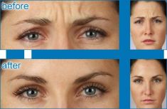 Botulinum toxin - Wrinkle Removal - Photo before - Dr Joni Feldman MBBS(MELBOURNE) MFFACCS