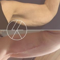 Arm Lift Surgery - Photo before - MUDr. Lucie Kalinová PhD.