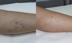 Sclerotization of varicose veins - Photo before - ARS ESTETICA – Klinika Medycyny Estetycznej i Laseroterapii