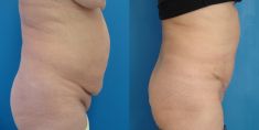 Abdominoplastika (Operace břicha) - fotka před - MUDr. Evžen Trupar Ph.D.