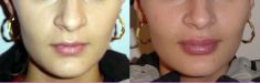 Lip augmentation - cheiloplasty - Photo before - Dr. Dobos Calin
