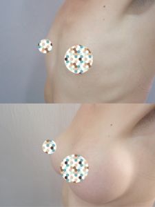 Zväčšenie prsníkov (Augmentácia) - Fotka pred - ENVY klinika estetickej medicíny