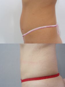 Liposukcia tumescenčná - Fotka pred - ENVY klinika estetickej medicíny