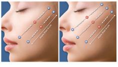 Lifting twarzy Silhouette Soft - Zdjęcie przed - HORIZON MEDICAL CENTER Klinika Medycyny Regeneracyjnej