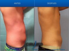 Criolipolisis - Foto Antes de - Cirumed Clinic