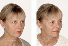 Hyaluronic acid-based wrinkle fillers - Photo before - Dr. Dobos Calin